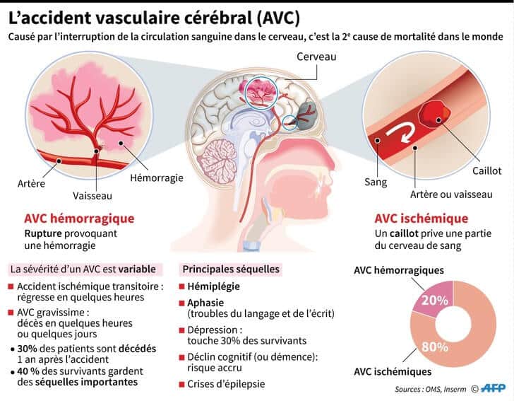 Les différentes formes de l'AVC
