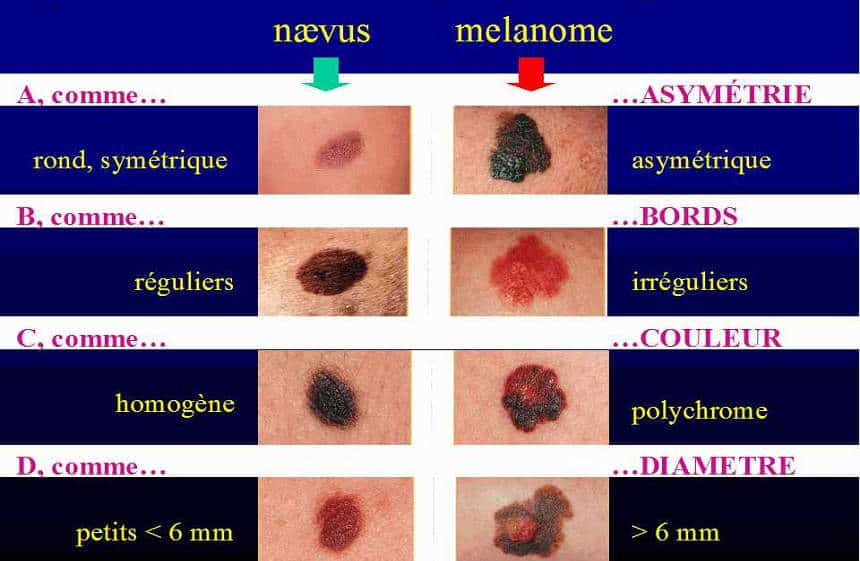 règle abcde cancer de la peau