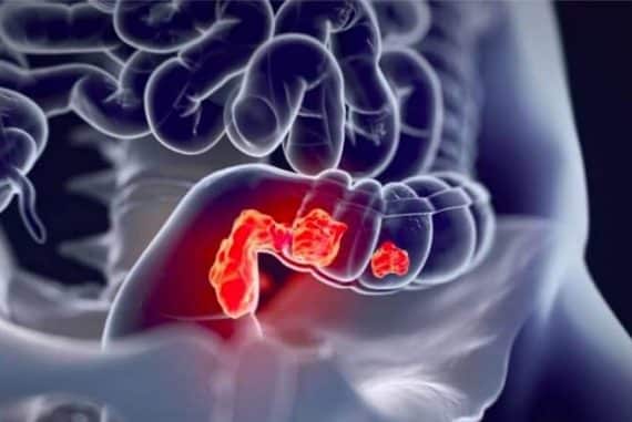 Cancer colorectal