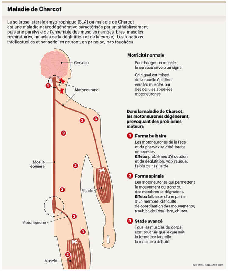 Infographie indiquant les différents symptômes de la maladie de charcot / SLA