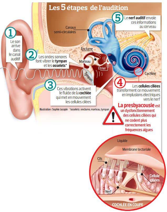 troubles auditifs 