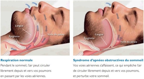 Apnée du sommeil définition