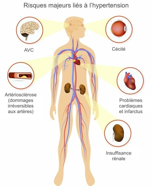 Risques majeurs liés à l'hypertension