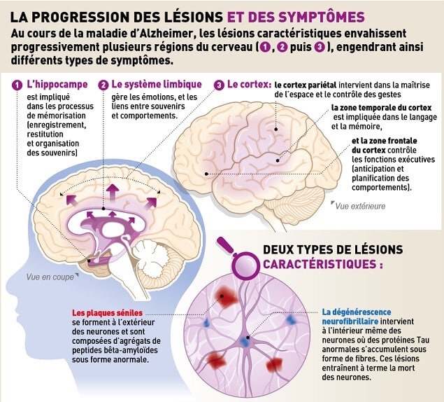 Causes de la maladie d'Alzheimer