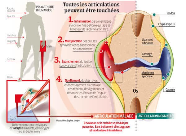 Infographie présentant les symptômes de la Polyarthrite rhumatoïde