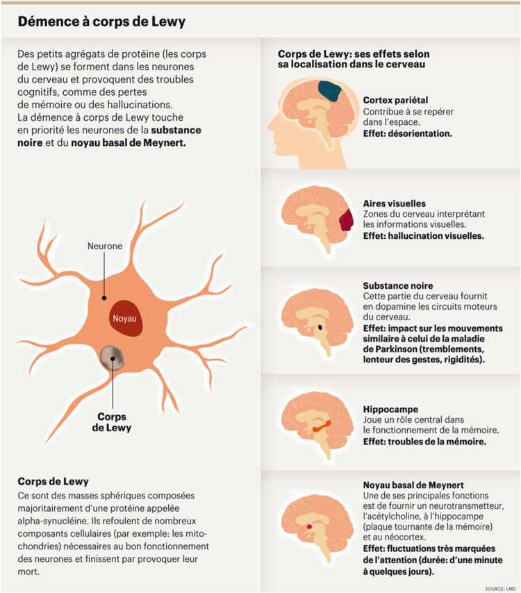Infographie indiquant les principaux symptômes de la Démence à corps de Lewy