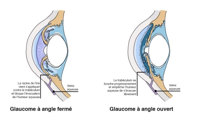glaucome angle ouvert et angle fermé