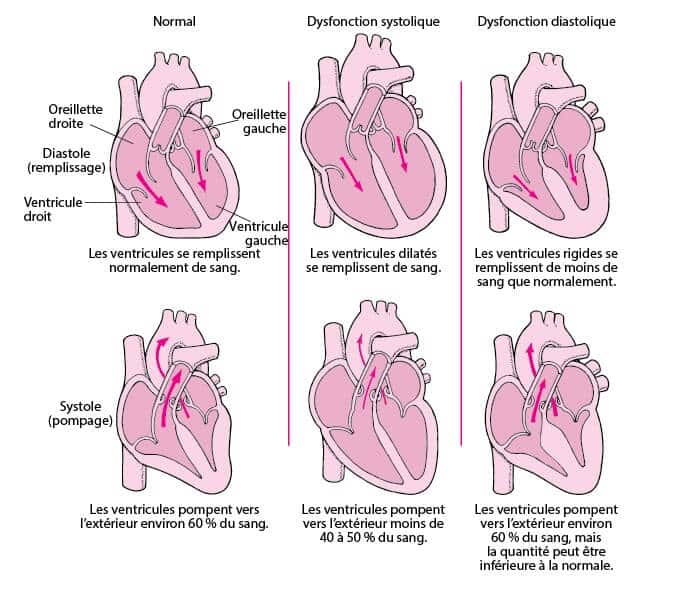 insuffisance cardiaque fonctionnement