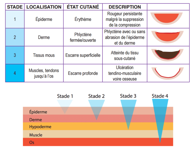 Infographie présentant la dégradation de l'état cutanée de la peau selon le stade de l'escarre