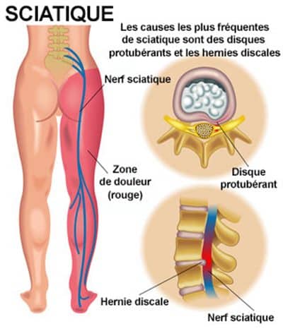sciatique définition